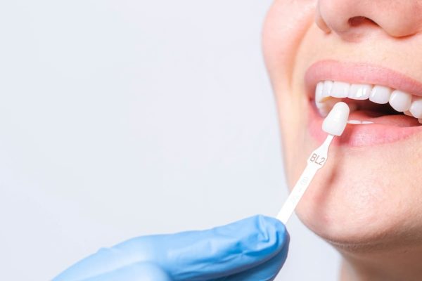 Banner tooth whitening, perfect white teeth close up with shade guide bleach color, female veneer smile, dental care and stomatology, dentistry, copyspace.
